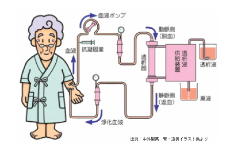 透析療法のイラスト